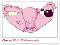 endometriozis